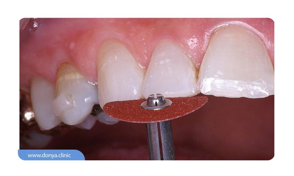 عکس از تراش خوردن مینای دندان