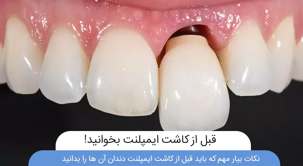 آمادگی های قبل از کاشت ایمپلنت دندان