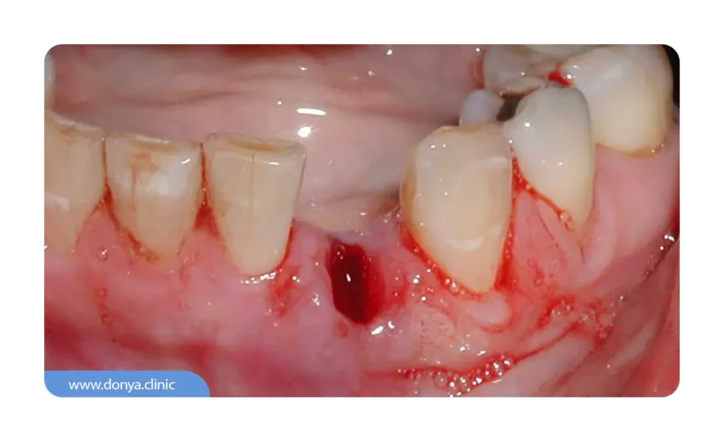 کاشت ایمپلنت فوری بعد از کشیدن دندان