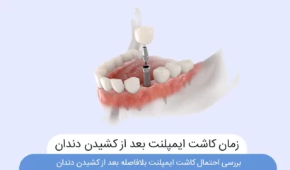 کاشت ایمپلنت بعد از کشیدن دندان