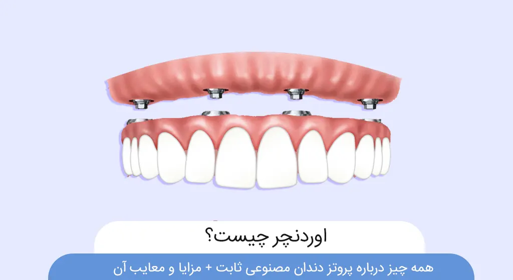 عکس اوردنچر دندان