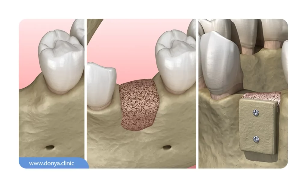 پیوند استخوان دندان