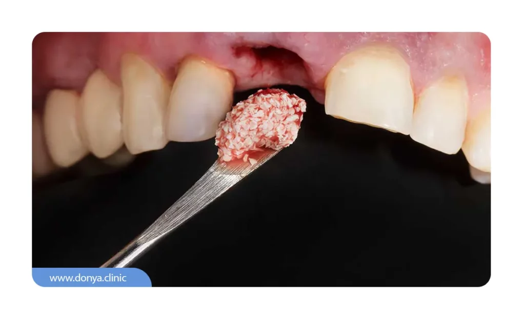 عکس پیوند استخوان واقعی قبل از ایمپلنت دندان