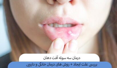 درمان سه سوته آفت دهان