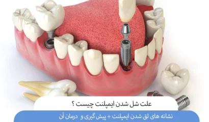 شل شدن ایمپلنت دندان