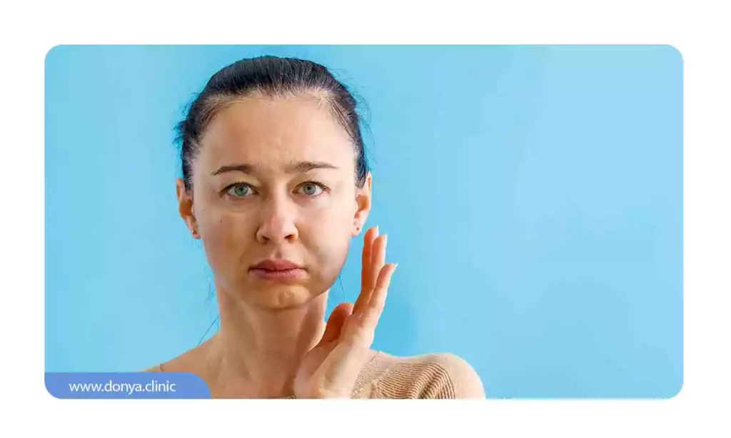 عکسی از ورم چهره یک خانم بعد از اجرای جراحی ایمپلنت دندان