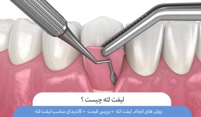 لیفت لثه چیست