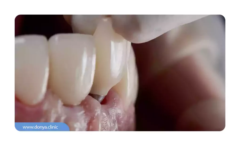 عکسی از شل شدن پایه ایمپلنت دندان