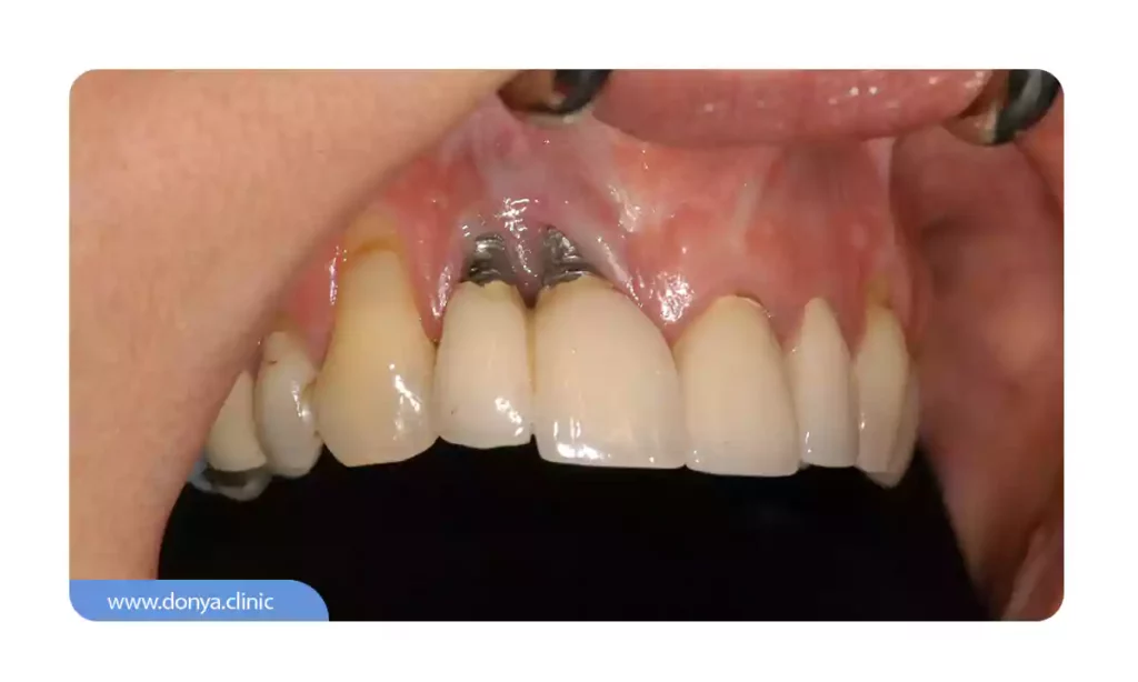 عکسی از شکستن ایمپلنت