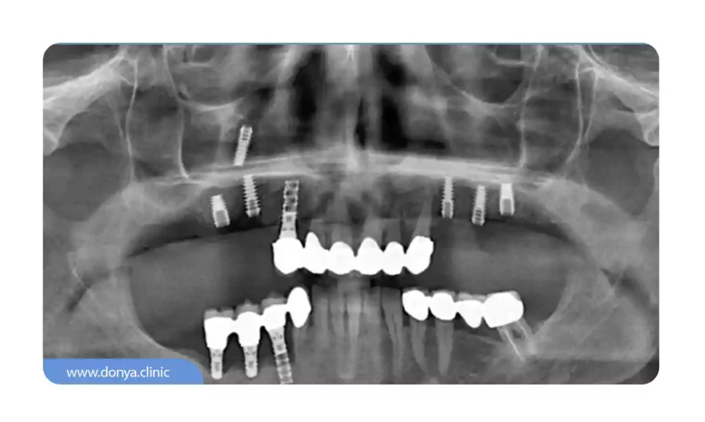 عکس رادیوگرافی دهان برای تشخیص افتادن ایمپلنت در سینوس