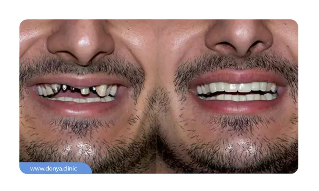 جزئیات قبل و بعد عکس ایمپلنت دندان جلو