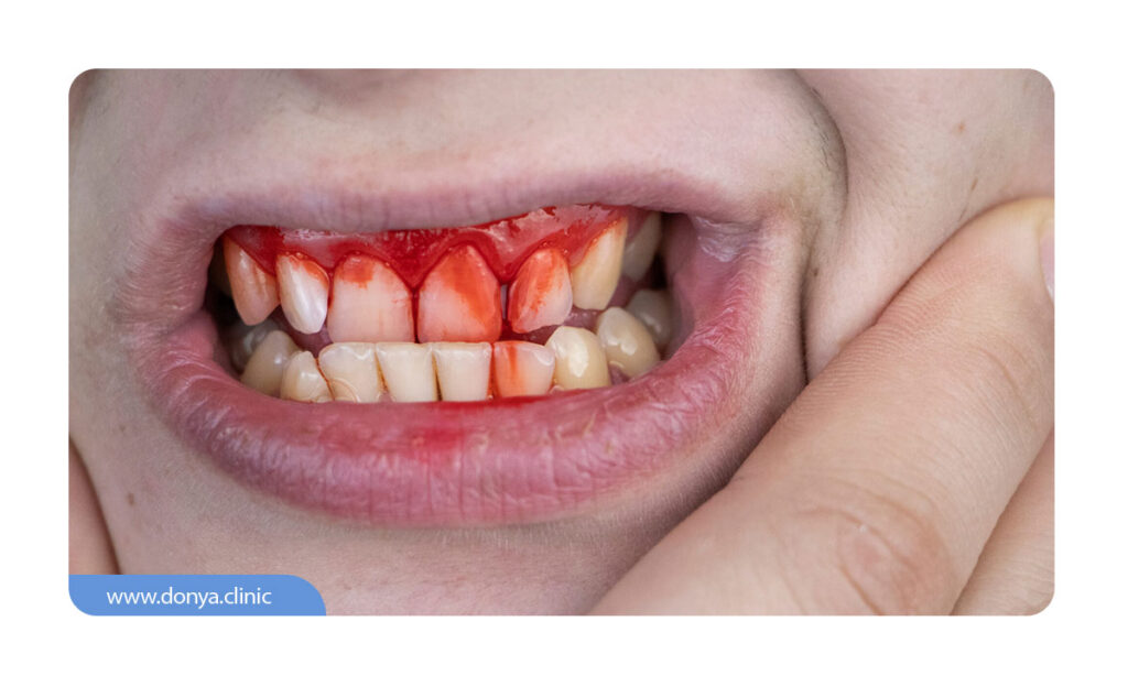 عکسی از خونریزی ایمپلنت دندان