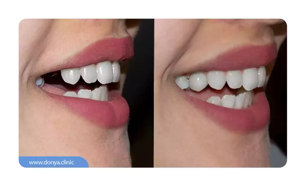 عکس اصلاح طرح لبخند با کاشت ایمپلنت دندان جلو