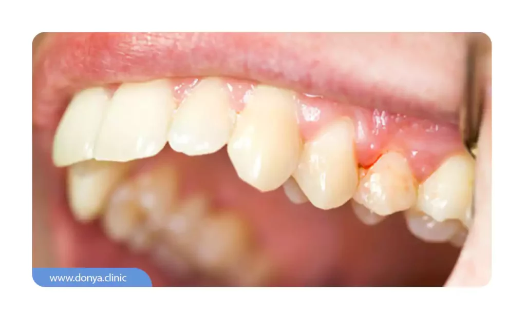 التهاب لثه بعد از کاشت ایمپلنت برای افراد سیگاری