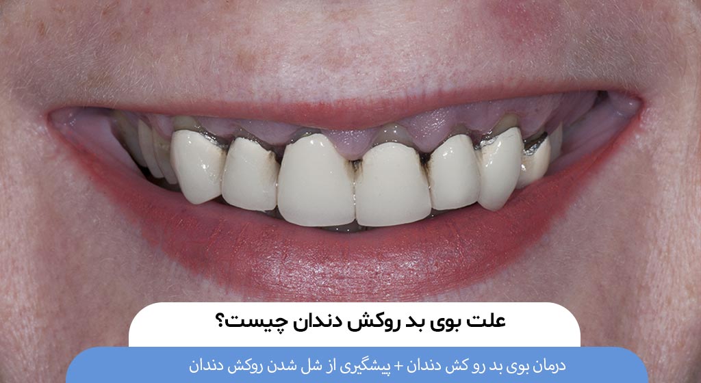 دلیل بوی بد روکش دندان چیست؟ + راهکارهای درمانی - دنیا دنتال | کلینیک ...