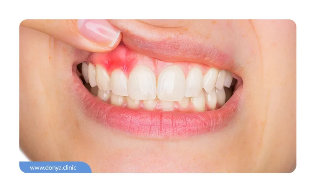التهاب لثه بعد از ایمپلنت