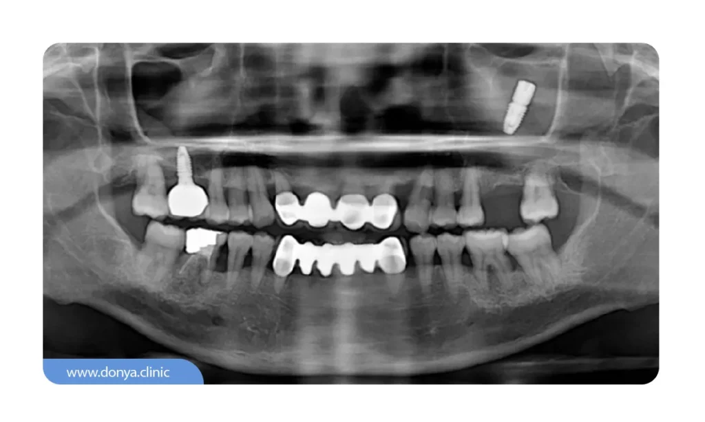 رادیوگرافی دهان برای تشخیص افتادن ایمپلنت در سینوس
