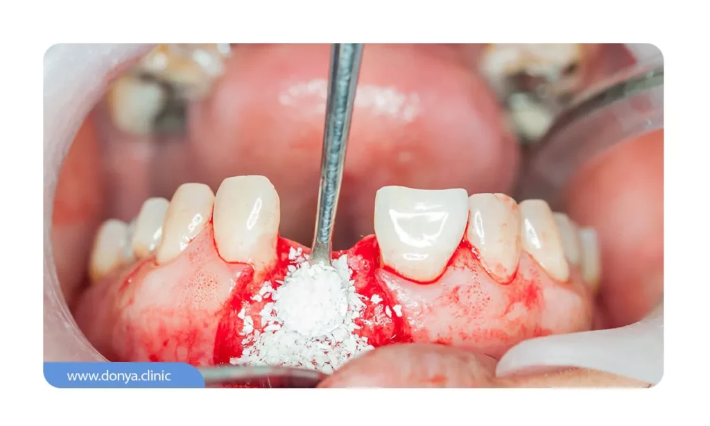 عمل پیوند استخوان برای کاشت ایمپلنت