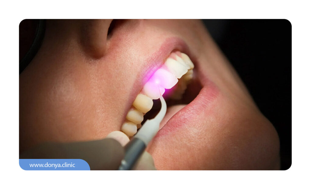 برداشتن لمینت دندان با لیزر