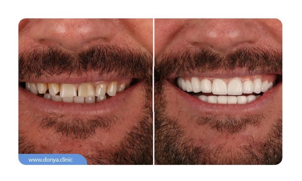 عکس قبل و بعد بلیچینگ دندان