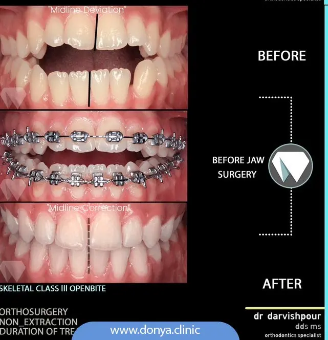 تصویر قبل و بعد از ارتودنسی