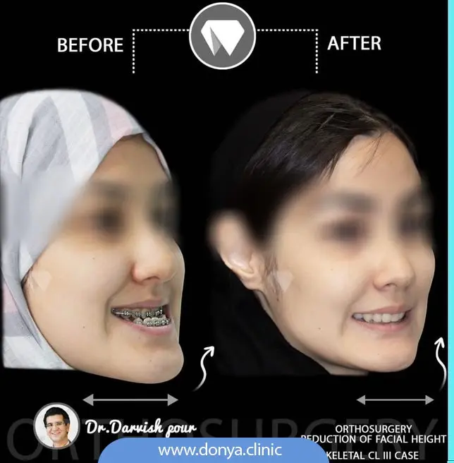 تصویر قبل و بعد از ارتودنسی