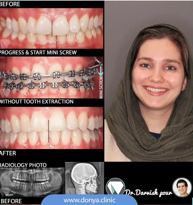 تصویر قبل و بعد از ارتودنسی