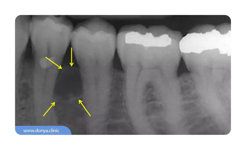 شکل کیست دندان کوچک