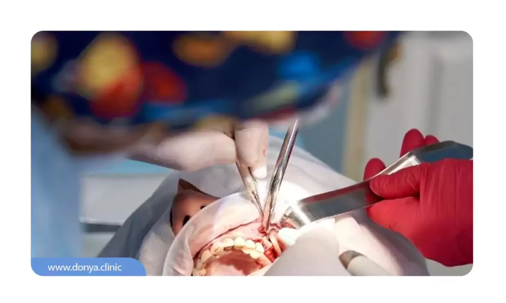 عکس از جراحی کیست دندان