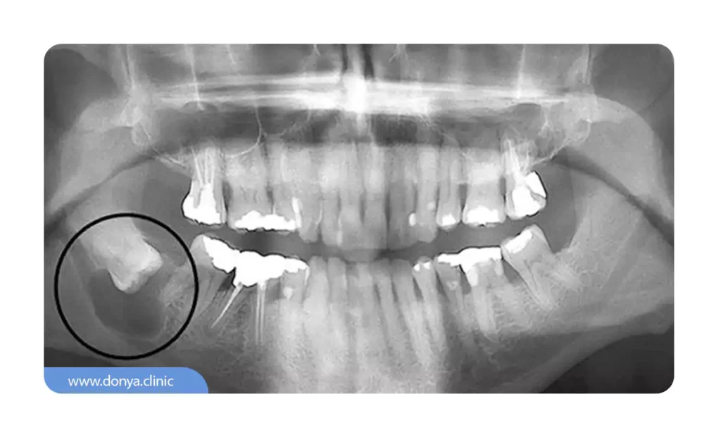 عکس کیست دندان در رادیولوژی
