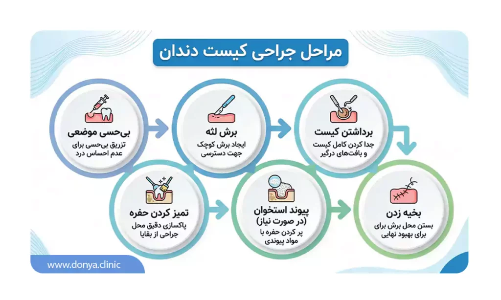 مراحل جراحی کیست دندان