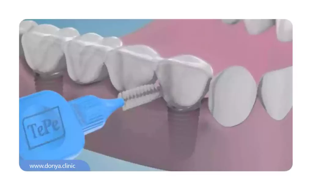 مسواک مخصوص ایمپلنت دندان