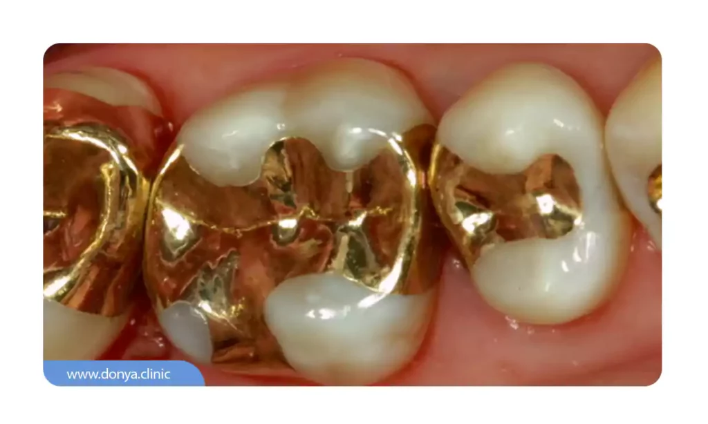 پر کردن دندان با طلا