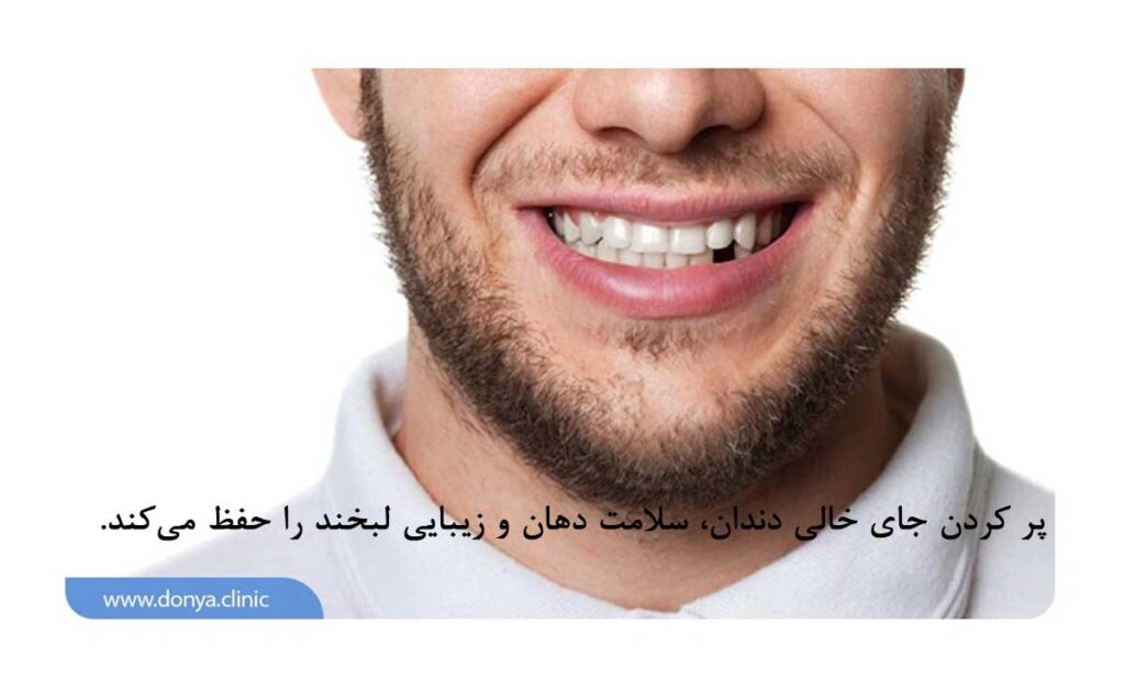 عکس جای خالی دندان در چهره