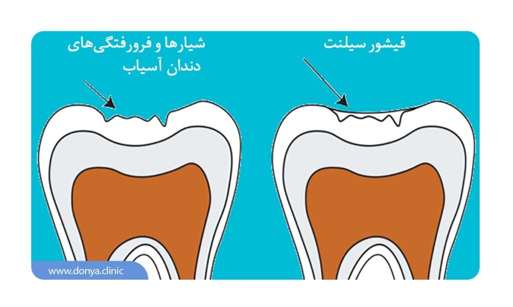 فیشور سیلانت