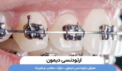 ارتودنسی دیمون