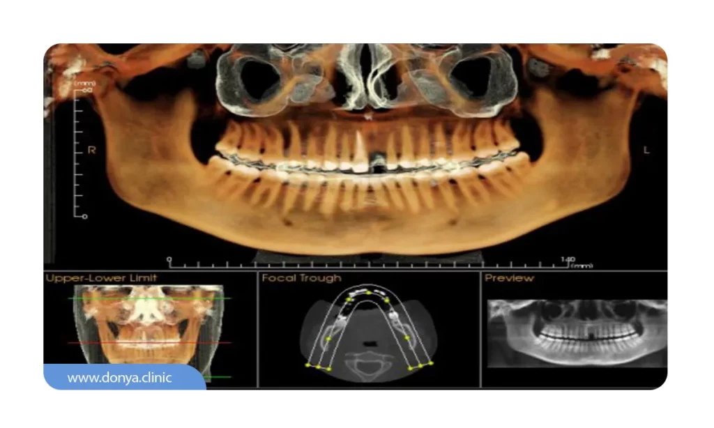 رادیوگرافی CBCT دهان