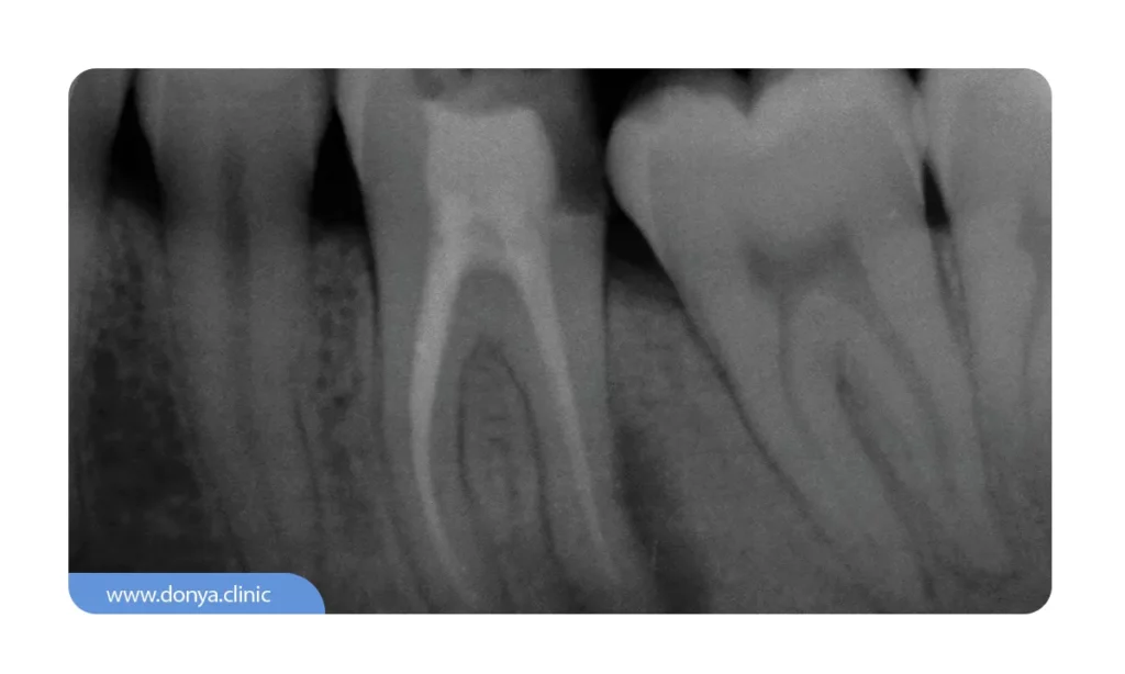 عکس دندان پری اپیکال