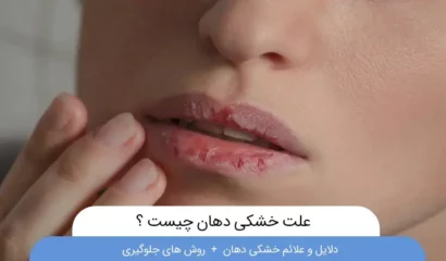 علت و درمان خشی دهان