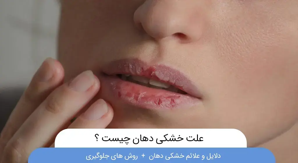 علت و درمان خشی دهان