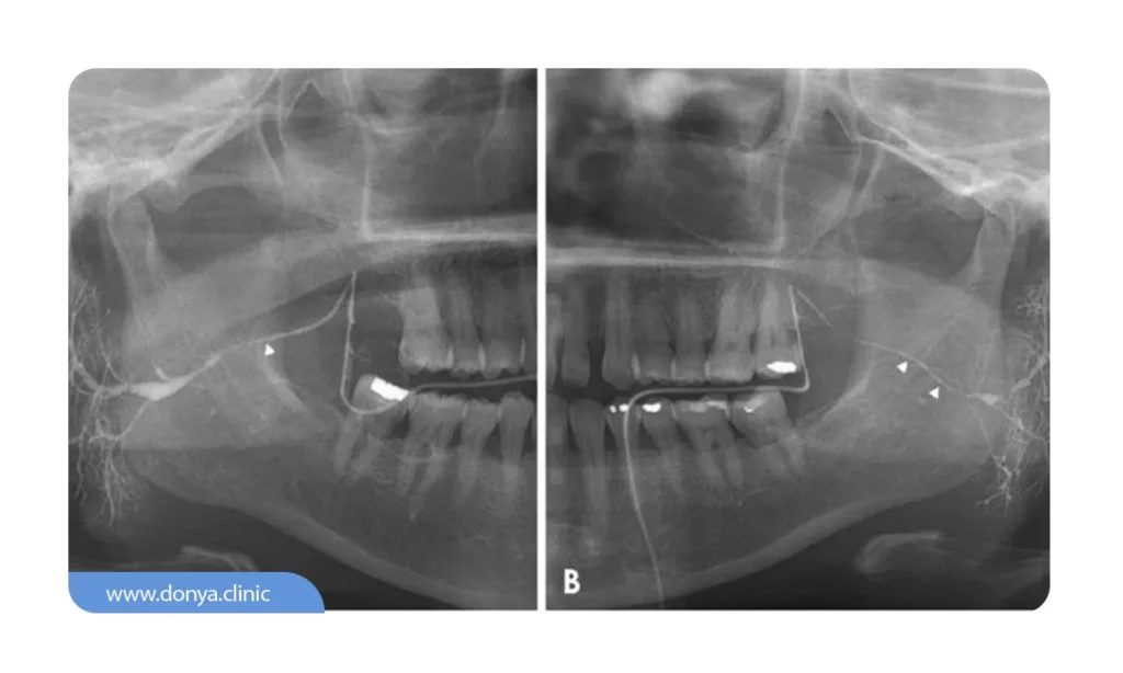 رادیوگرافی سیالوگرافی دهان