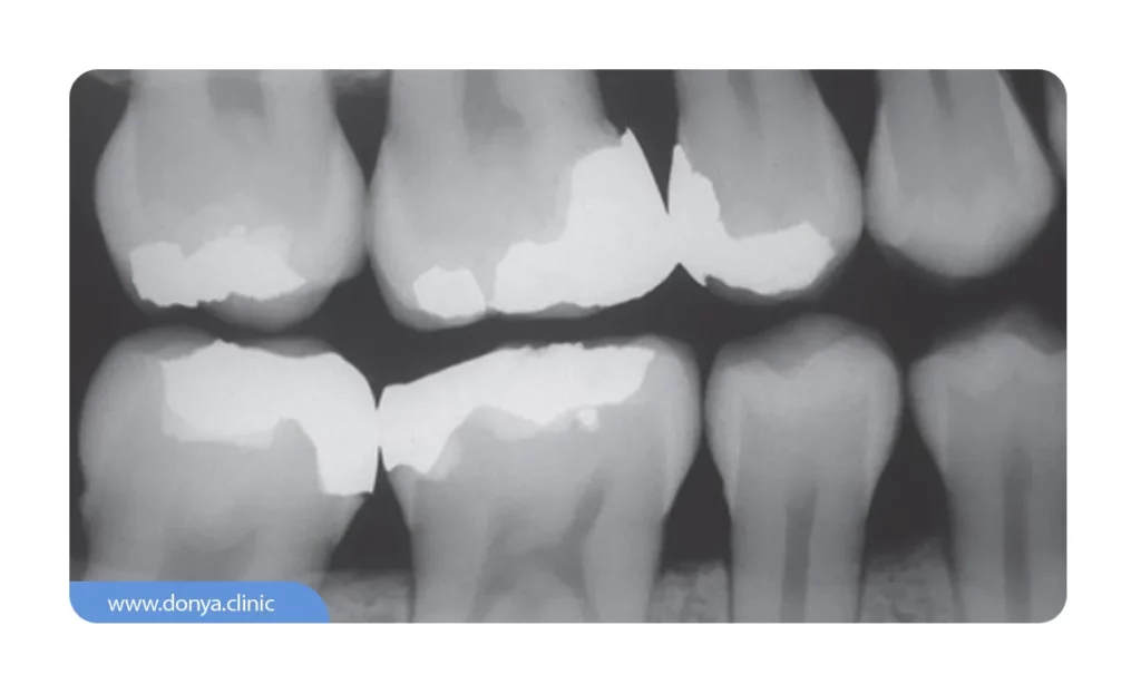 عکس بایت وینگ دندان