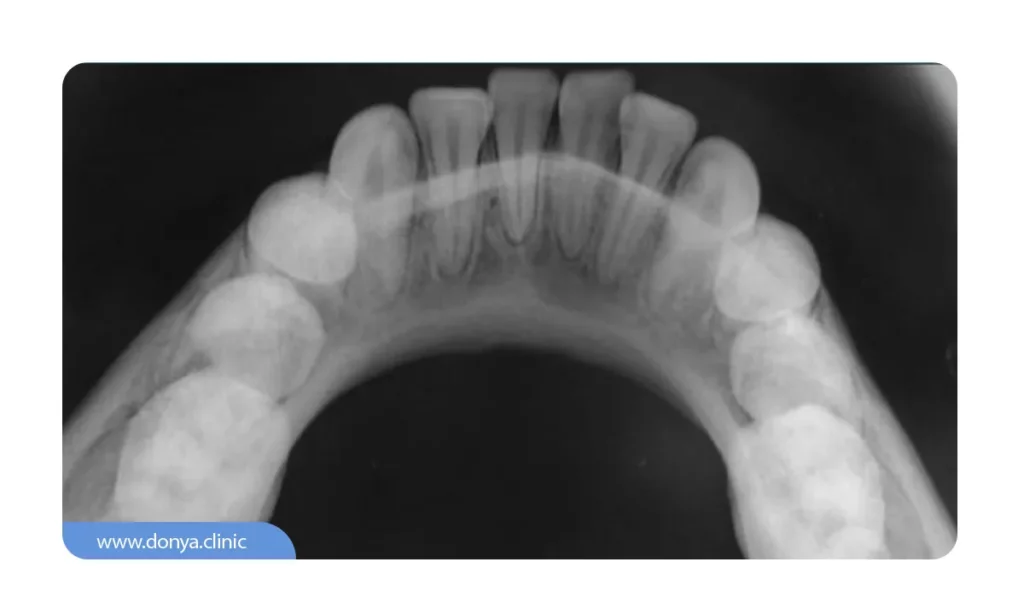 عکس دندان اکلوزال