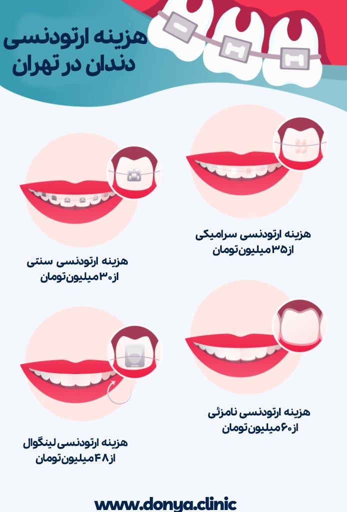 هزینه انواع ارتودنسی 