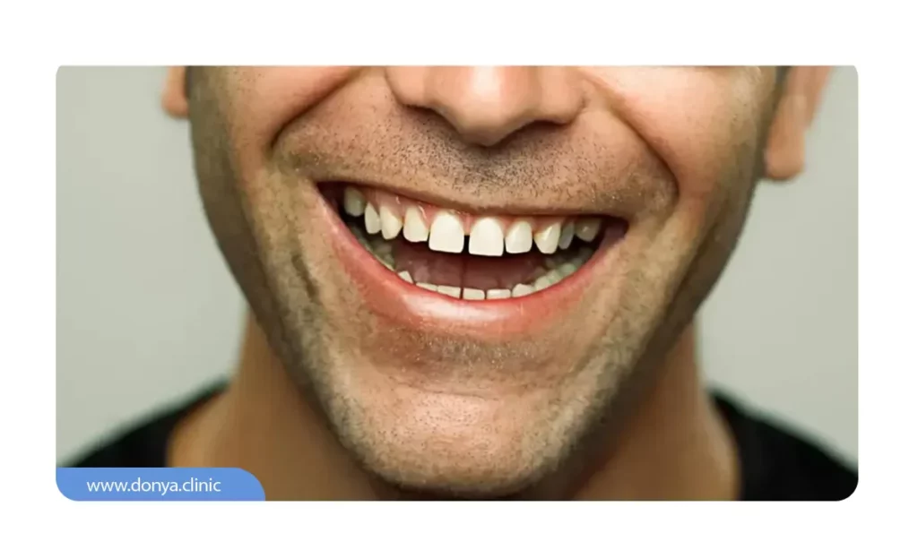 عکسی از فاصله بین دندان ها در حالت غیرطبیعی