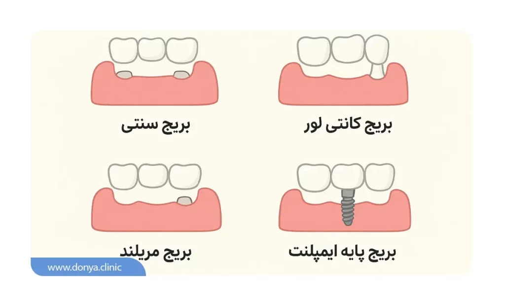انواع بریج دندان 