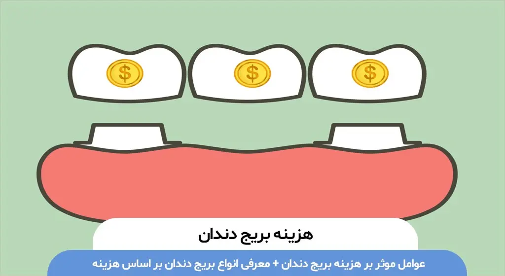 هزینه بریج دندان