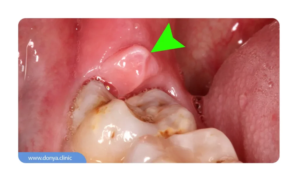 عکسی از دندان عقل نهفته