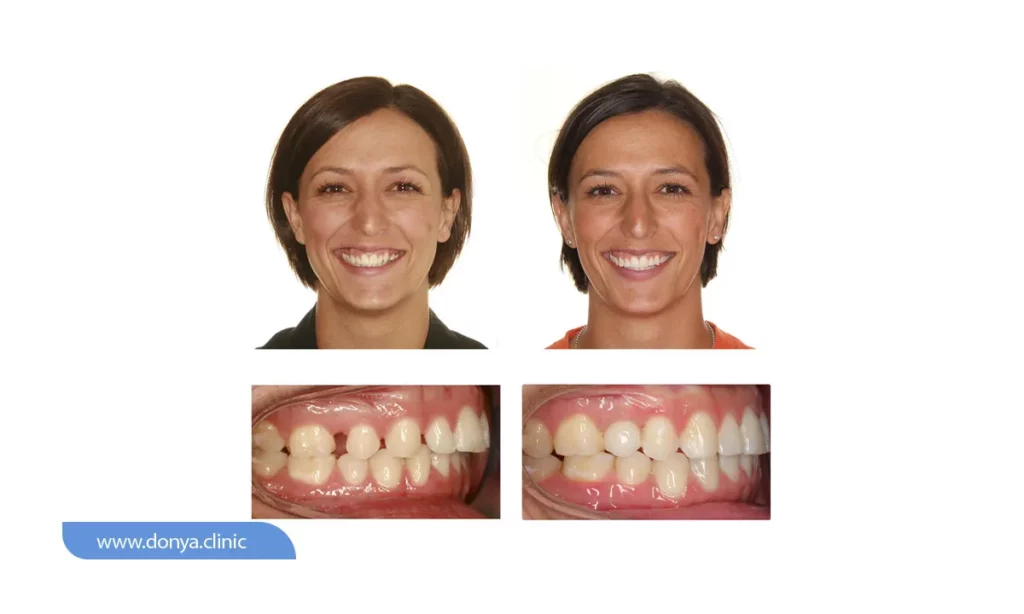 بستن فاصله بین دندان ها با ارتودنسی