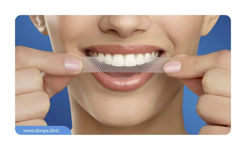 عکس براکت دندان نواری